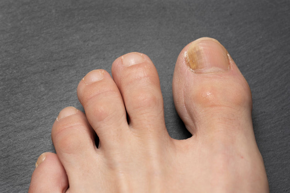 What is Tinea Unguium (a Fungal Nail Infection), and How Can I Treat It?