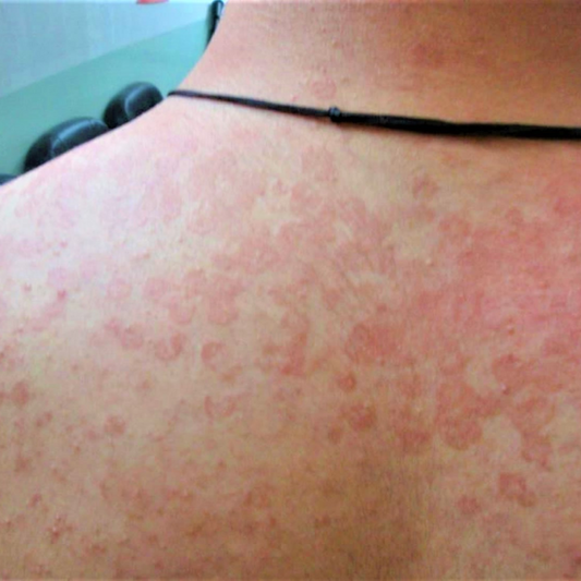 Can Tinea Versicolor Be Cured?