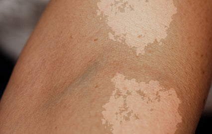 What is Tinea Versicolor?