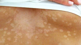 What is Tinea Versicolor, and How Can I Treat It?