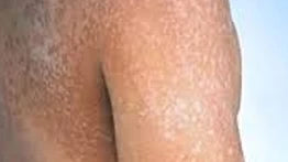 What Does Tinea Look Like?